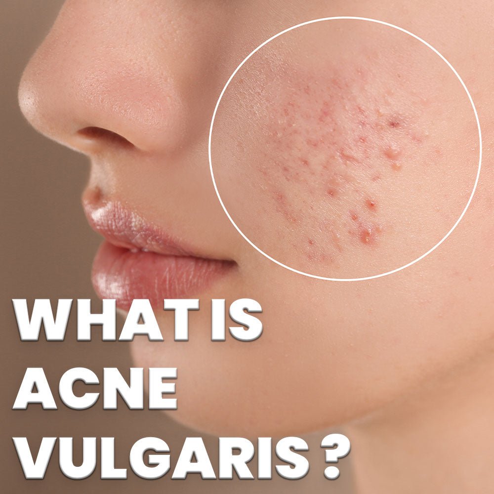 What is Acne Vulgaris? - Acne-X Topical