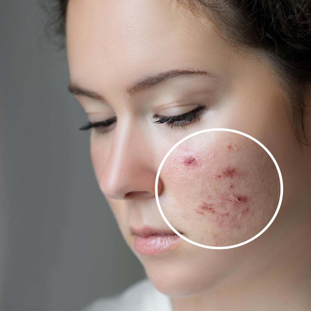  A young woman with acne scars seeks treatment for her skin condition, hoping to regain her confidence and achieve a clear complexion.