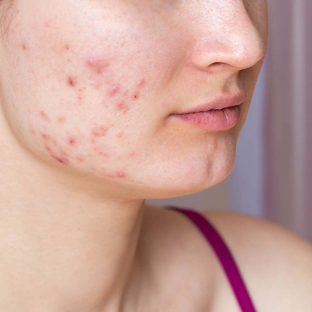 a girl having acne problems and seeking skincare solutions for a clearer complexion