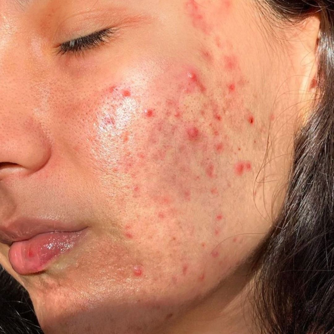 Acne Vulgaris: A Comprehensive Guide to Understanding, Managing, and Overcoming Common Skin Troubles - Acne-X Topical