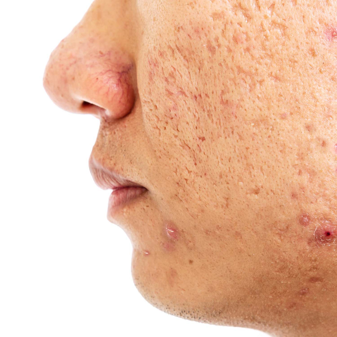 Discover the realities of acne scars with this close-up image, highlighting the textured aftermath of healed acne, from shallow indentations to subtle skin discolorations—a testament to the journey of skin healing.