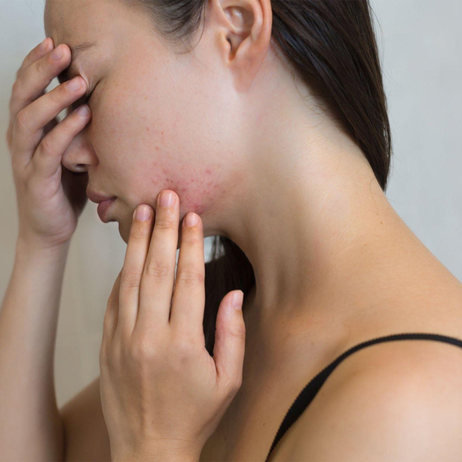 The Psychosocial Burden of Acne: Defying Doubts and Conquering Acne Dilemma with Acne-X Topical. - Acne-X Topical