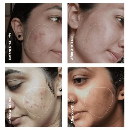 RESCUE: Acne Spot Treatment - Acne-X Topical